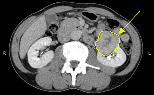 腎細胞がんCT
