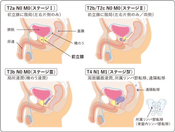 前立腺がんのステージ分類