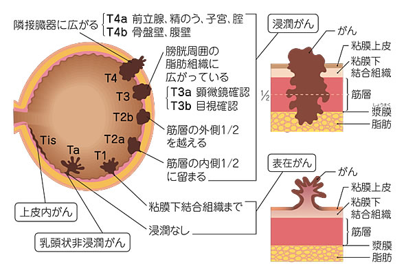 膀胱がんのステージ分類