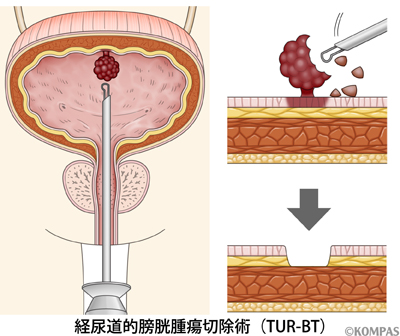 経尿道的膀胱腫瘍切除術のイメージ