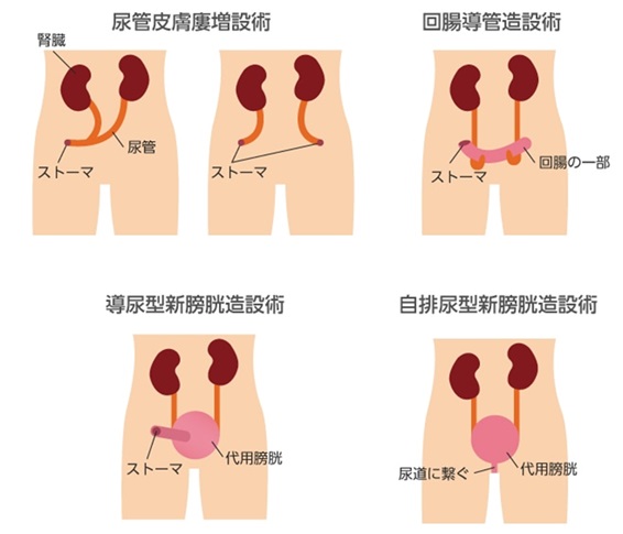 尿路変更術のイメージ